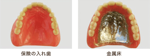 金属床義歯