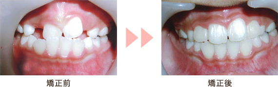 矯正前と矯正後