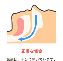 正常な場合