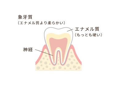 むし歯の進行度を知って、早めの対策を!