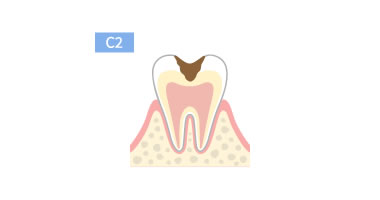 C2:痛みを感じる前に!「象牙質まで進行したむし歯」