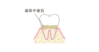 歯肉炎(初期段階)